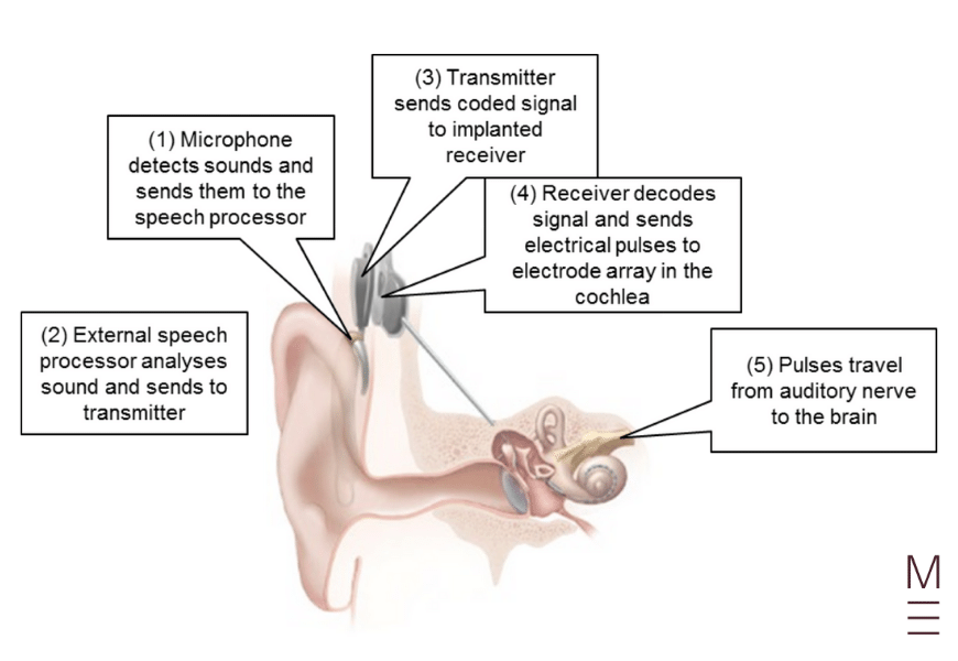 guide-biology-year-12-module-8-non-infectious-disease-and-disorders-cochlear-implant