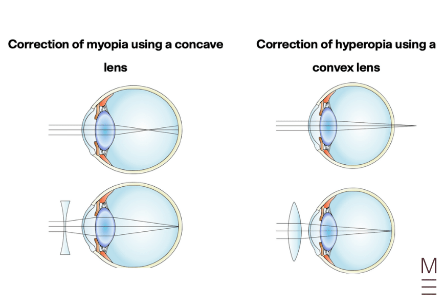 guide-biology-year-12-module-8-non-infectious-disease-and-disorders-correction-myopia-hyperopia